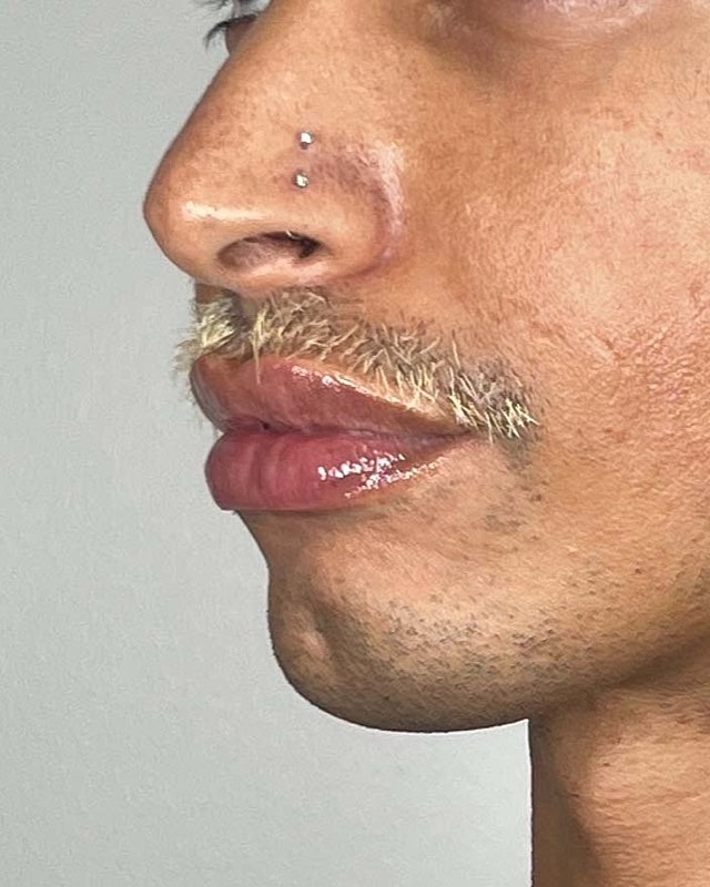 Juvederm Before & After