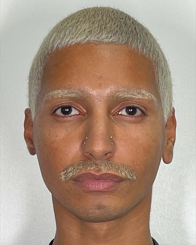 Juvederm Before & After