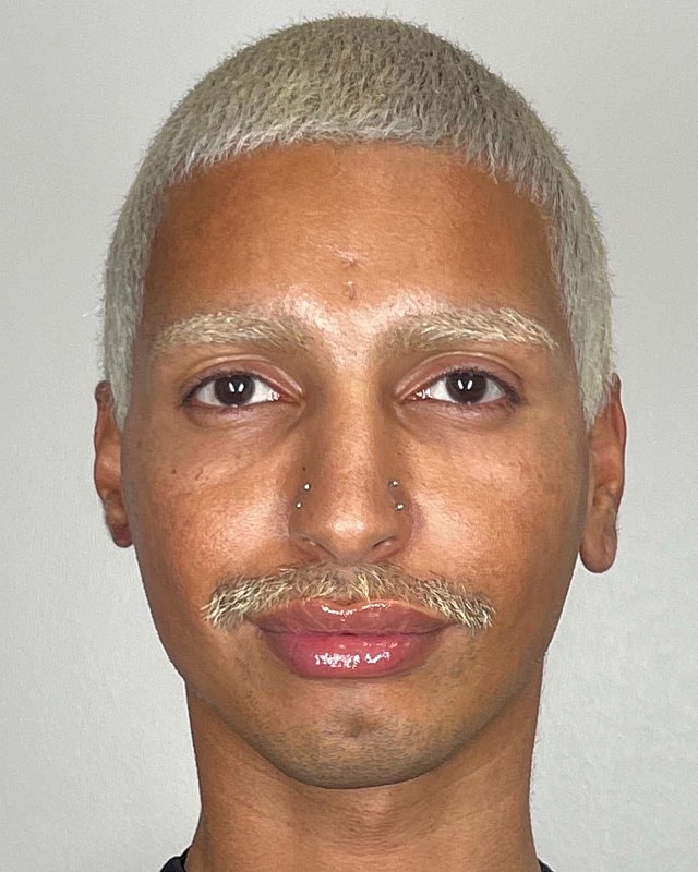Juvederm Before & After