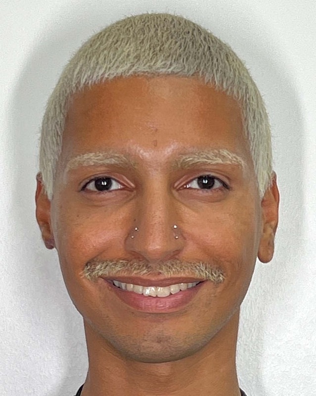 Juvederm Before & After