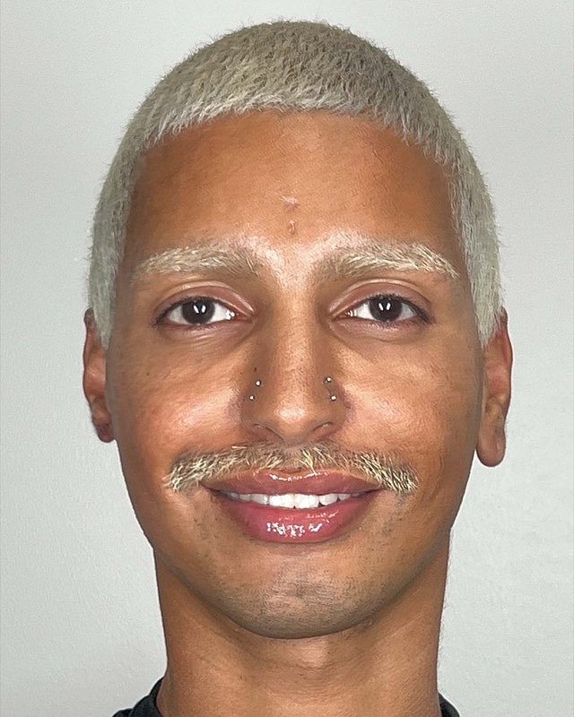 Juvederm Before & After