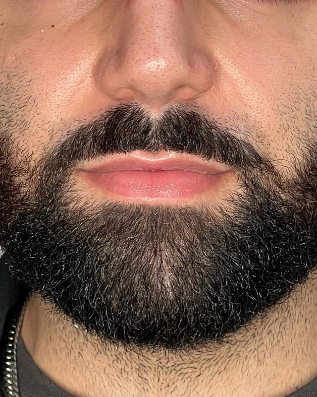 Juvederm Before & After