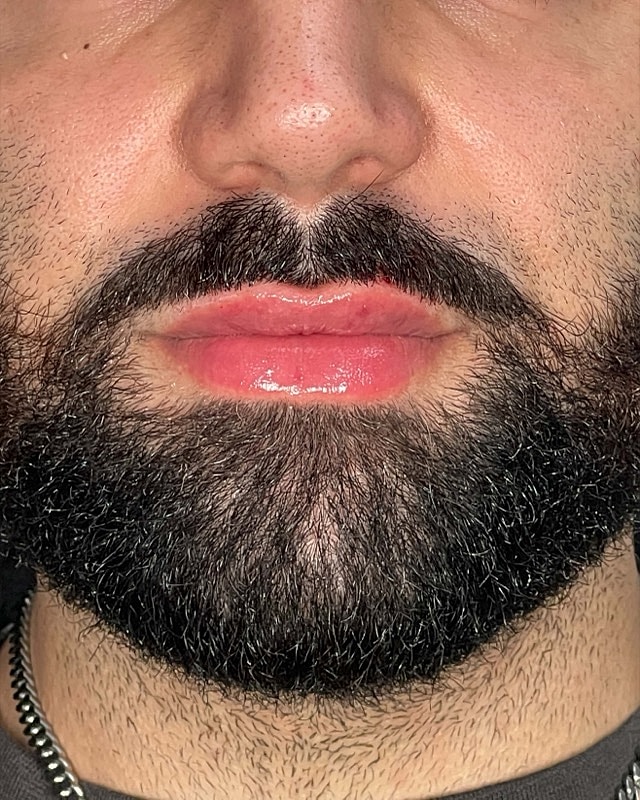 Juvederm Before & After