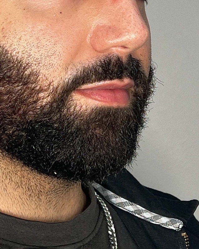 Juvederm Before & After