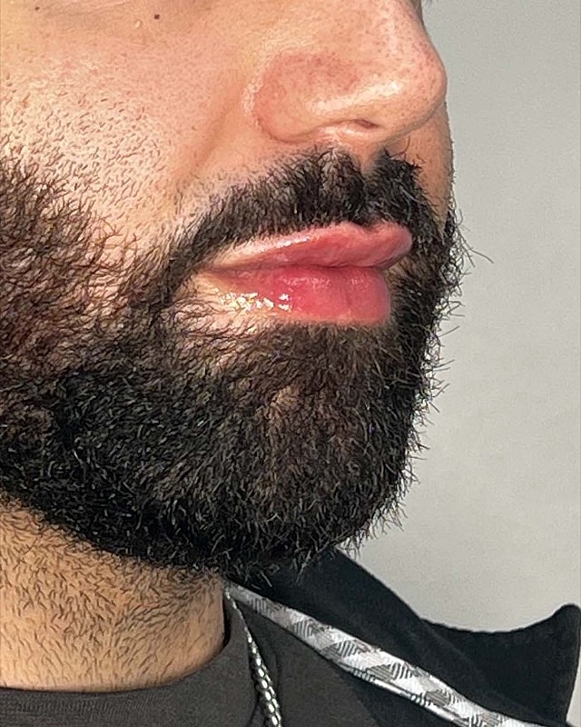 Juvederm Before & After