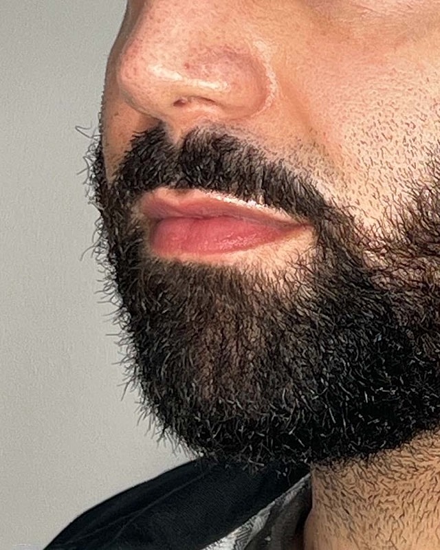 Juvederm Before & After