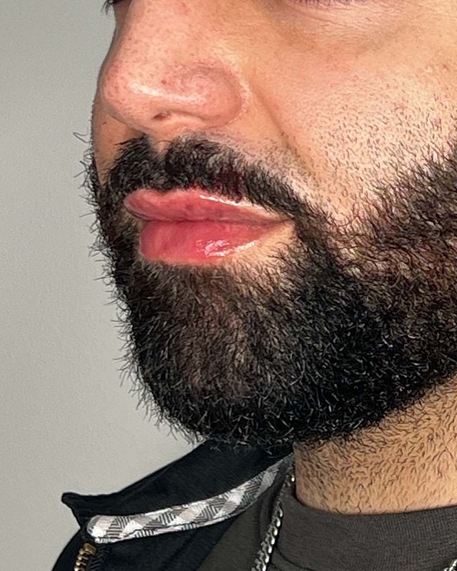 Juvederm Before & After
