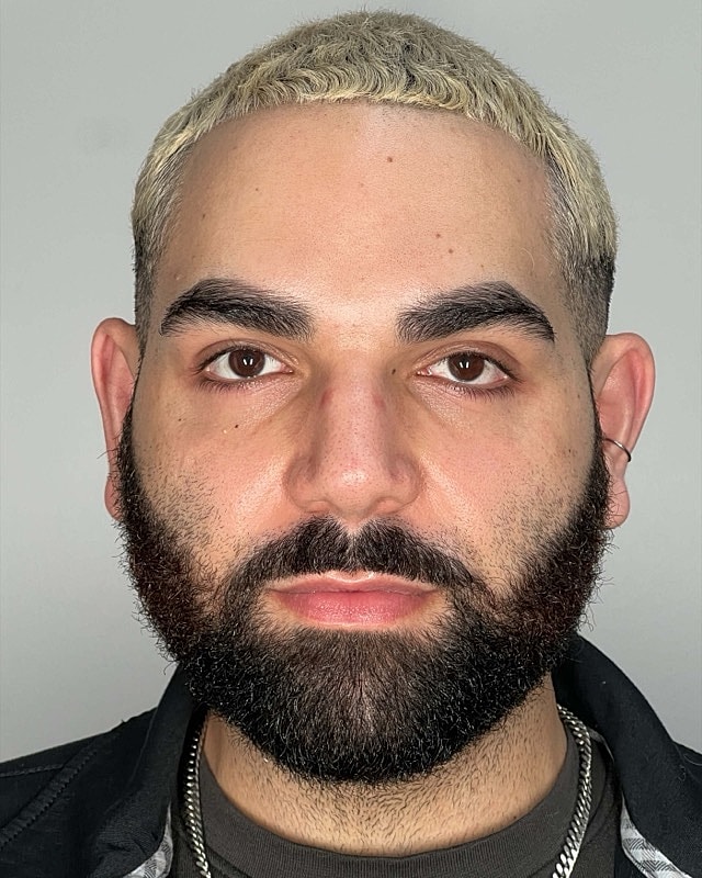 Juvederm Before & After