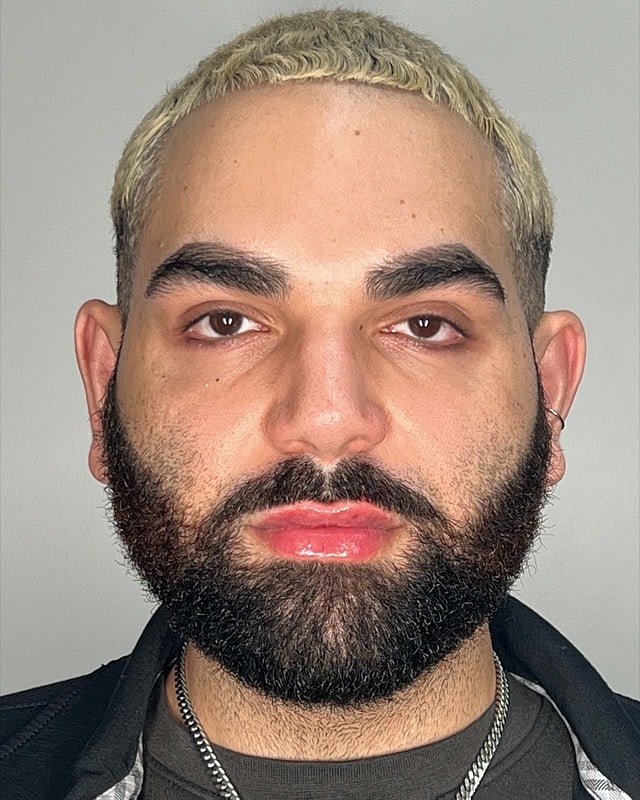 Juvederm Before & After