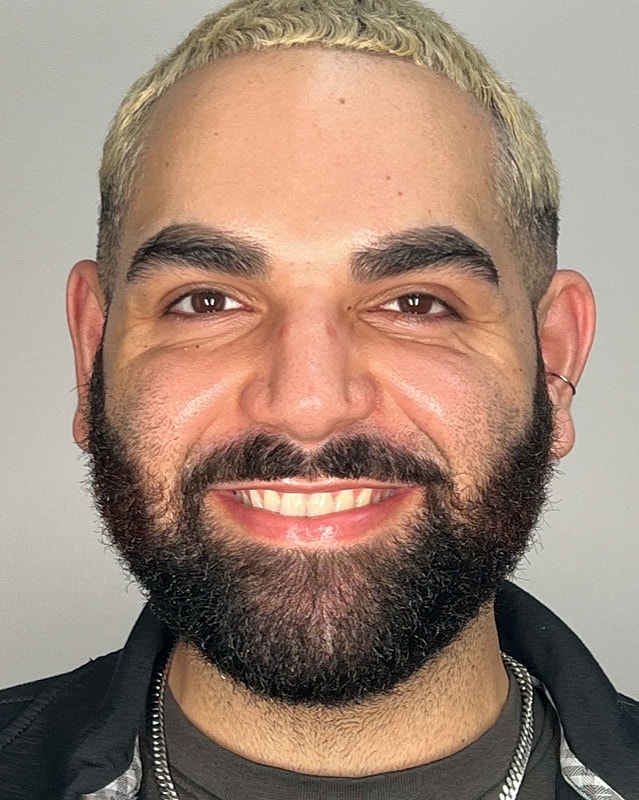 Juvederm Before & After