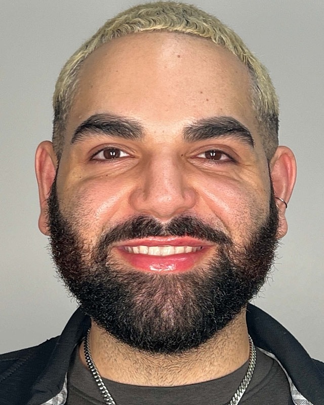 Juvederm Before & After