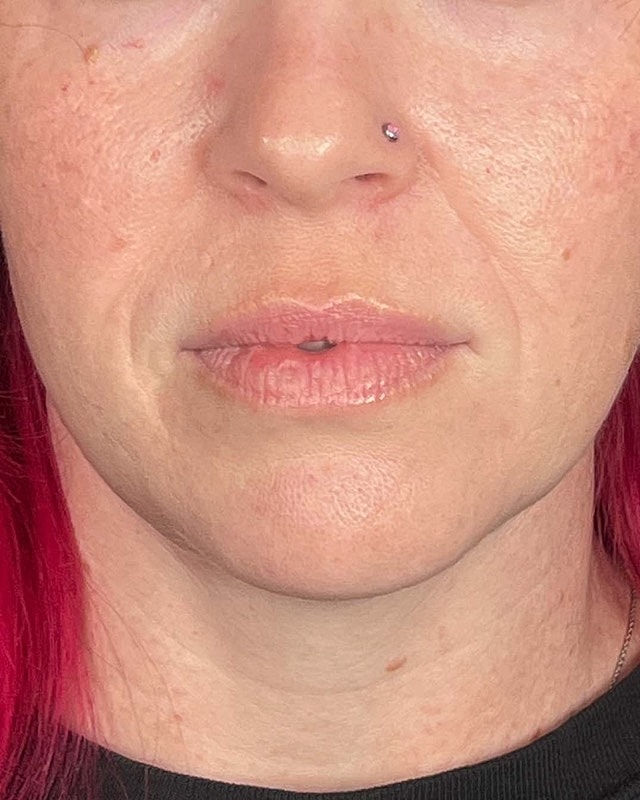 Juvederm Before & After