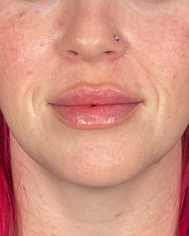 Juvederm Before & After