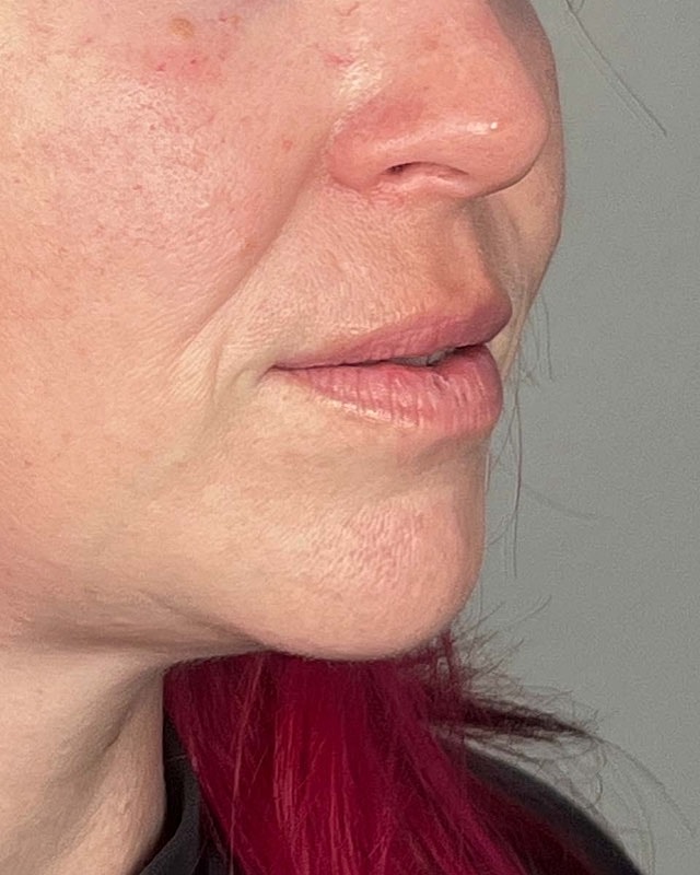 Juvederm Before & After