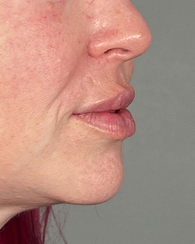 Juvederm Before & After