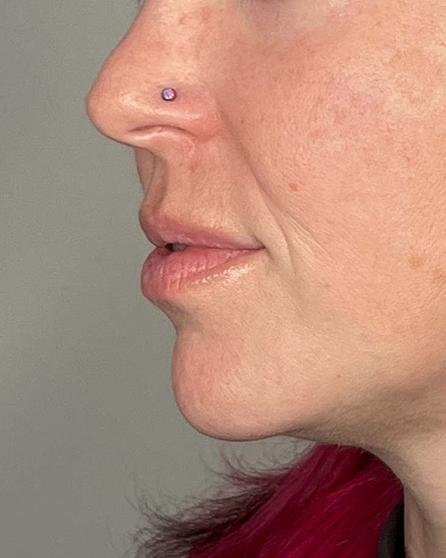 Juvederm Before & After