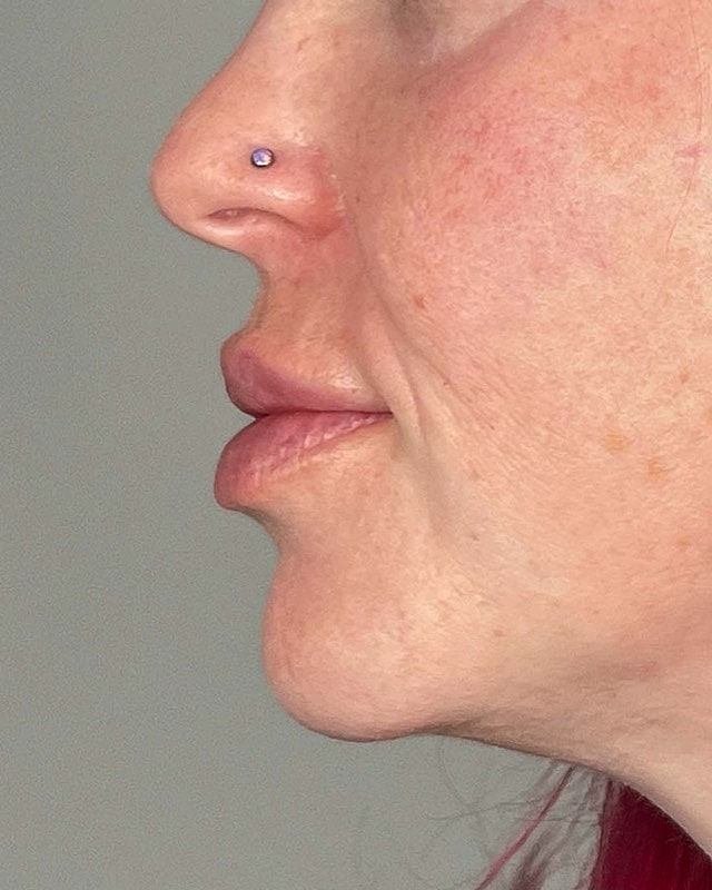 Juvederm Before & After