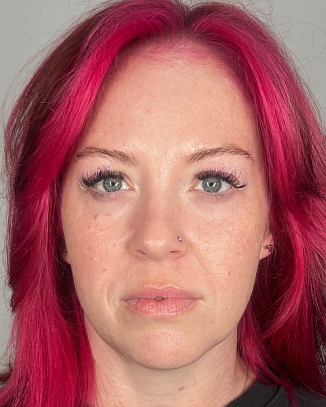 Juvederm Before & After