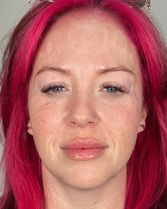 Juvederm Before & After