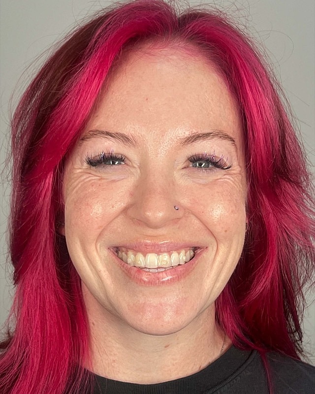 Juvederm Before & After