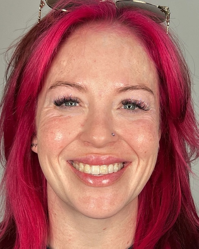 Juvederm Before & After
