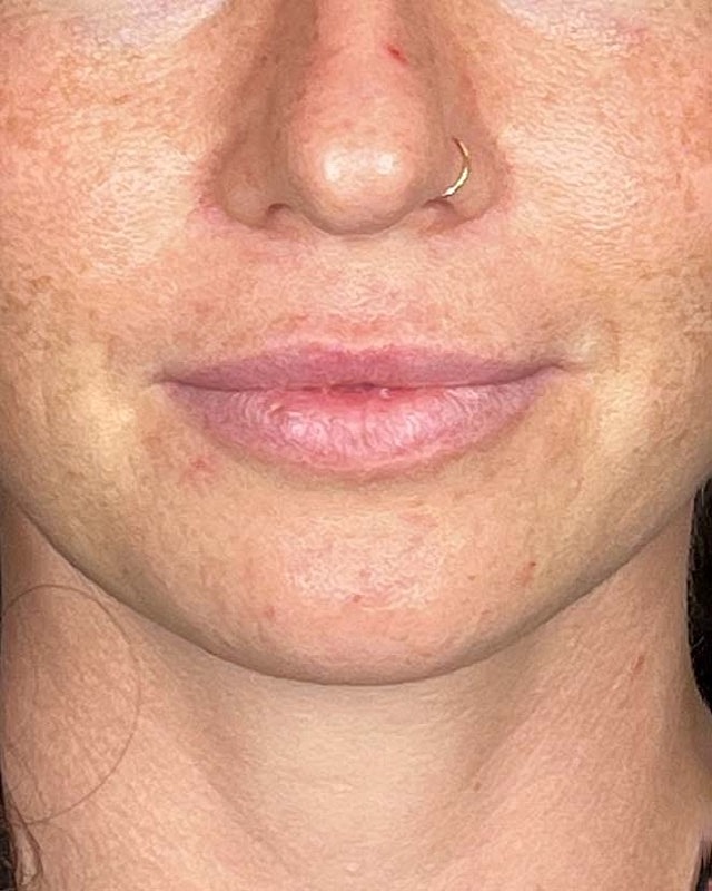Juvederm Before & After