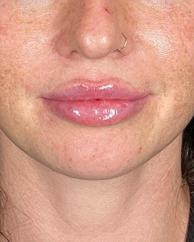 Juvederm Before & After