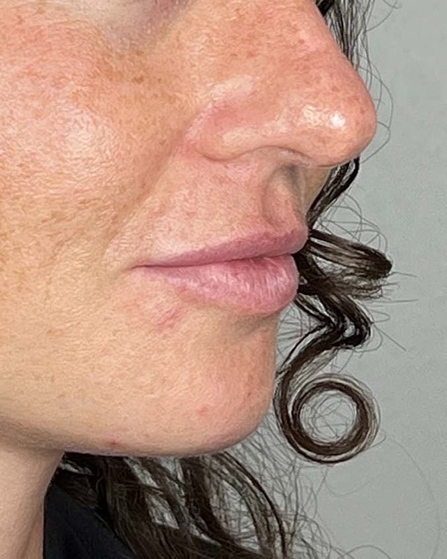 Juvederm Before & After