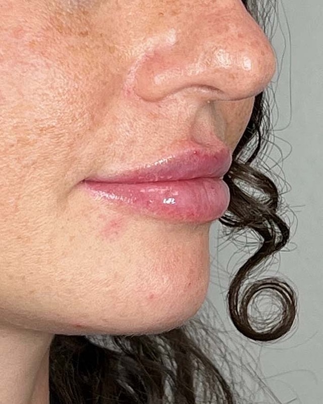 Juvederm Before & After
