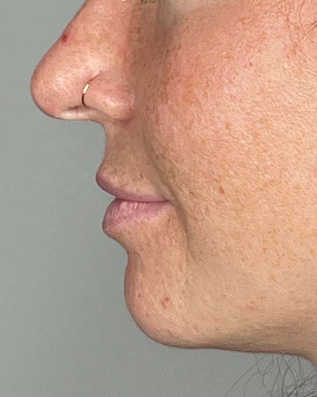 Juvederm Before & After