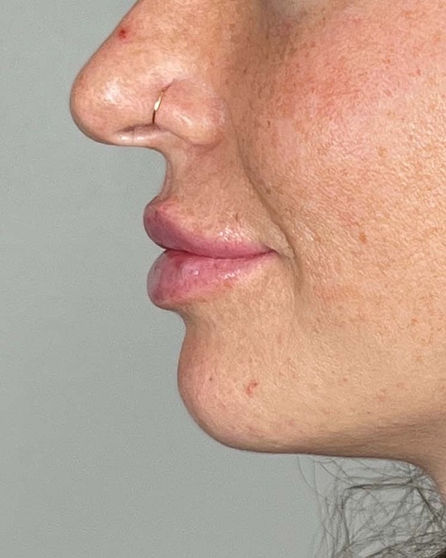 Juvederm Before & After