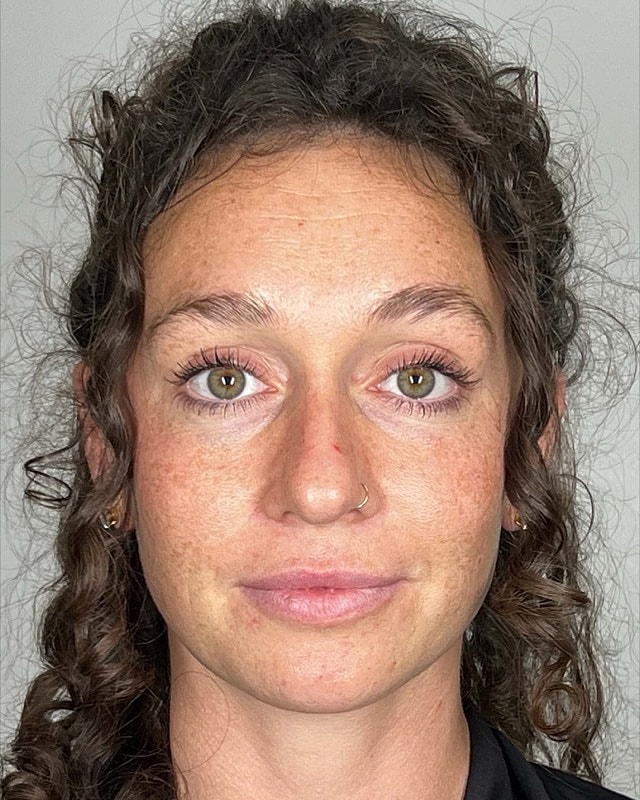 Juvederm Before & After