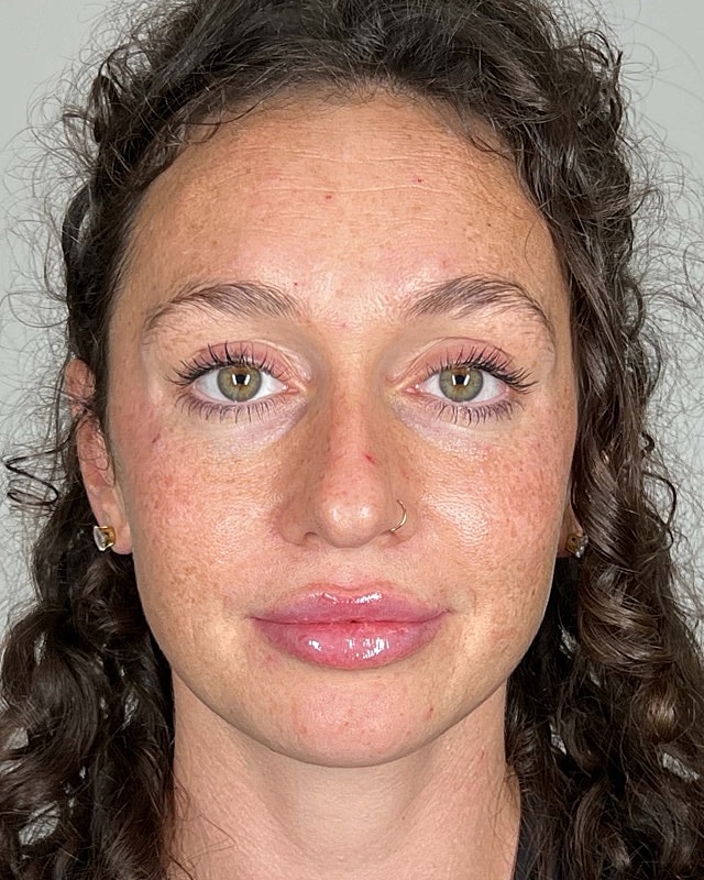 Juvederm Before & After
