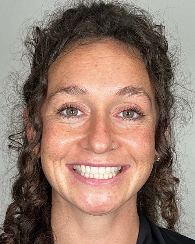 Juvederm Before & After