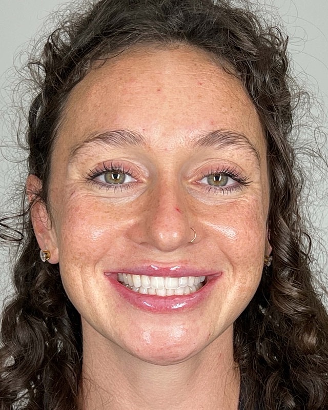 Juvederm Before & After