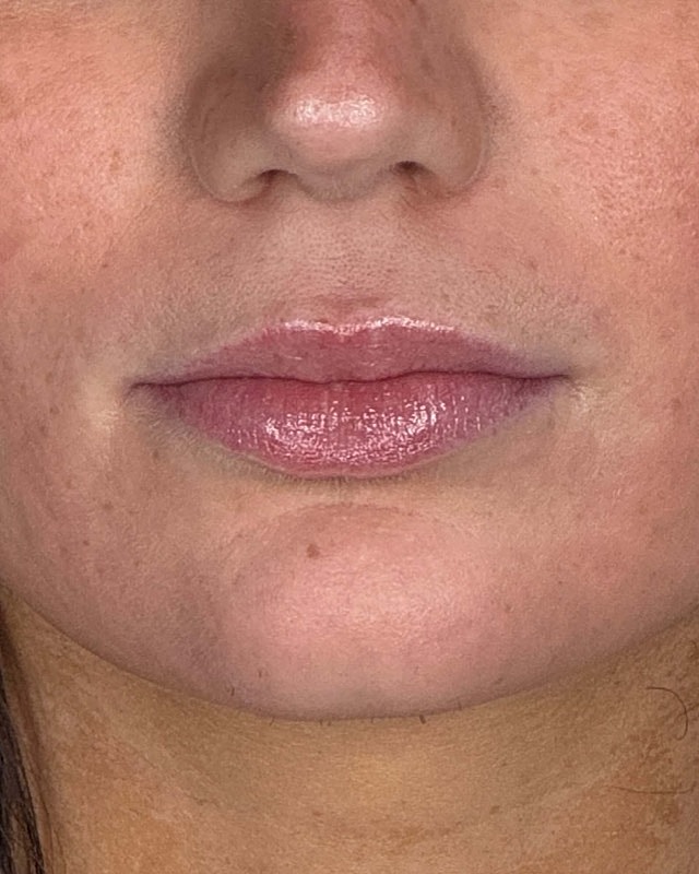 Juvederm Before & After