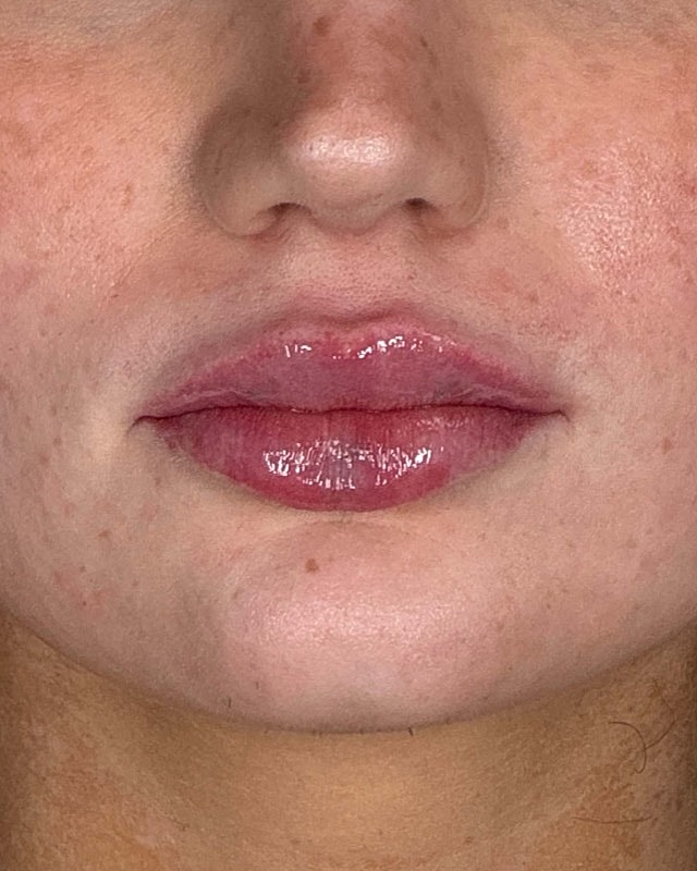 Juvederm Before & After