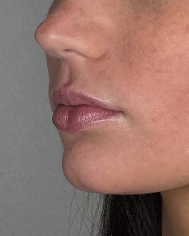 Juvederm Before & After