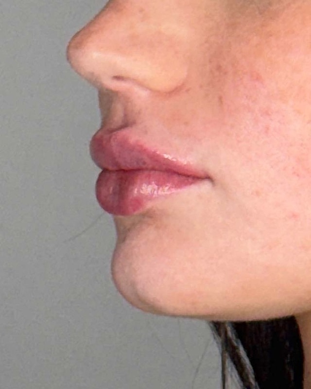 Juvederm Before & After