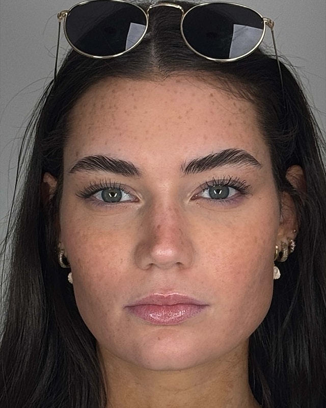 Juvederm Before & After