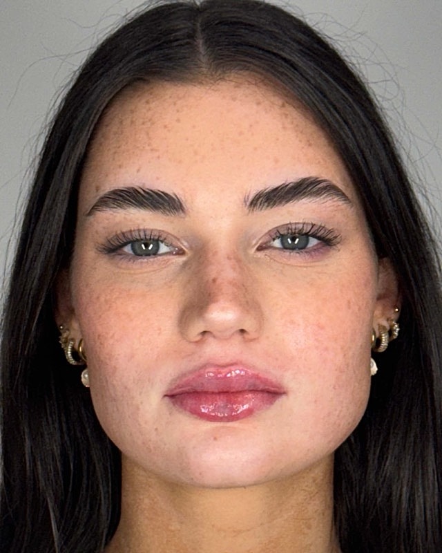 Juvederm Before & After