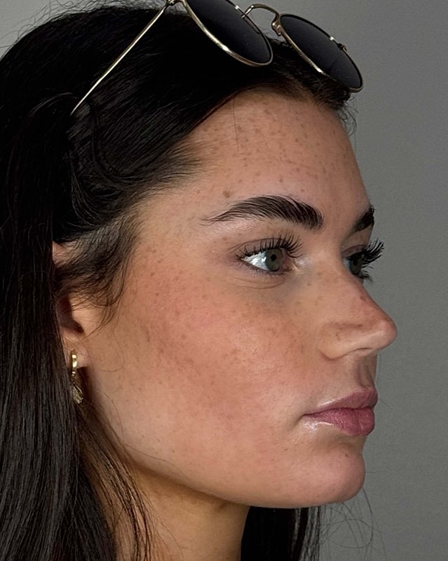 Juvederm Before & After