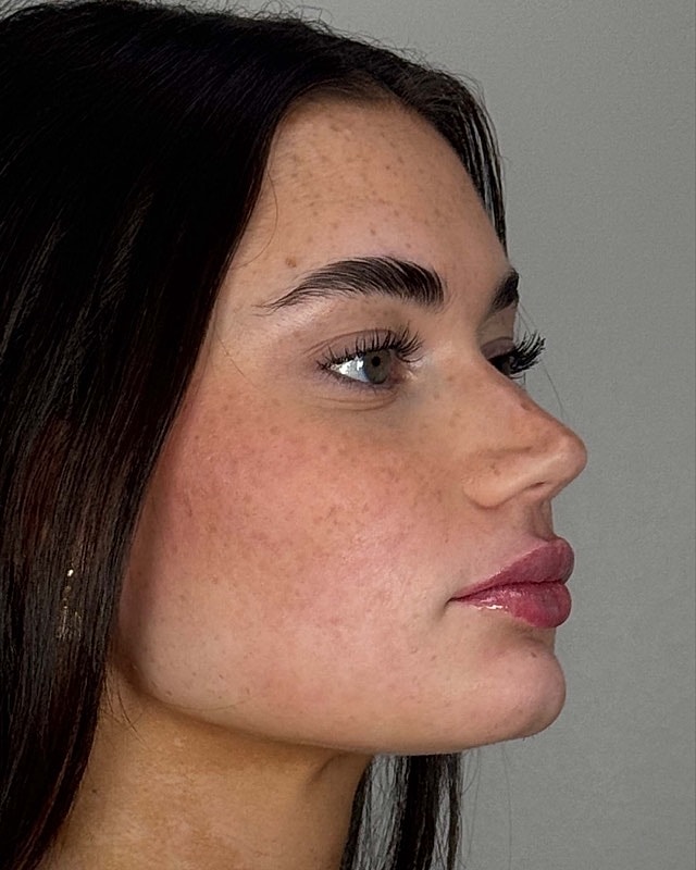 Juvederm Before & After