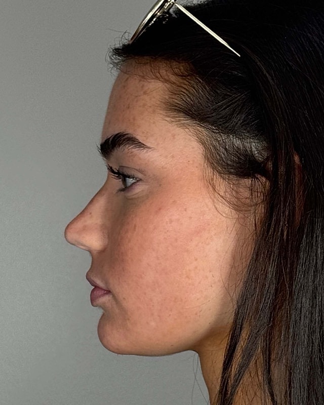 Juvederm Before & After