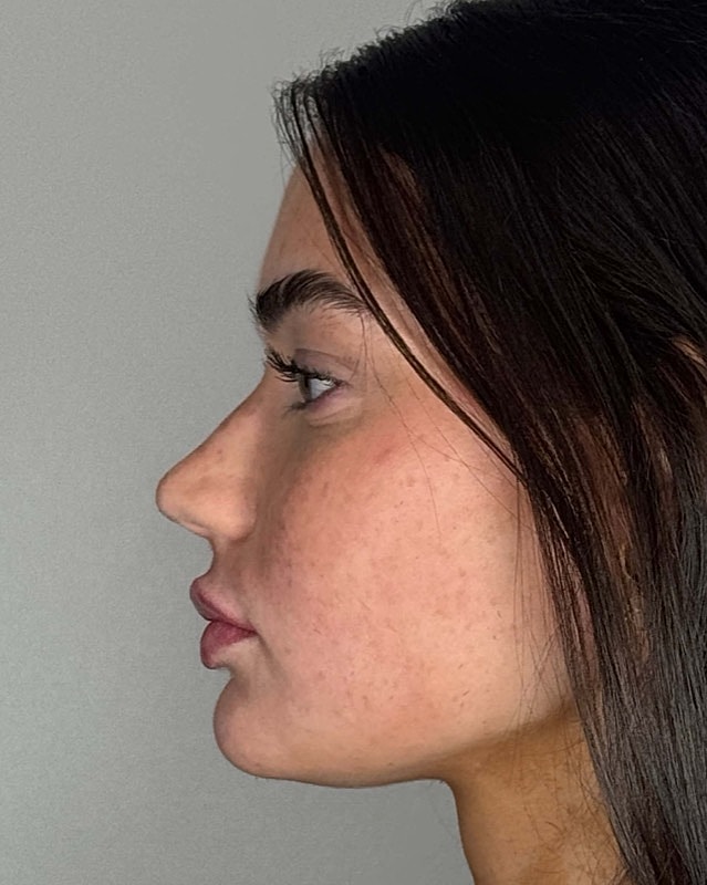 Juvederm Before & After