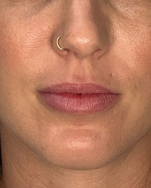 Juvederm Before & After