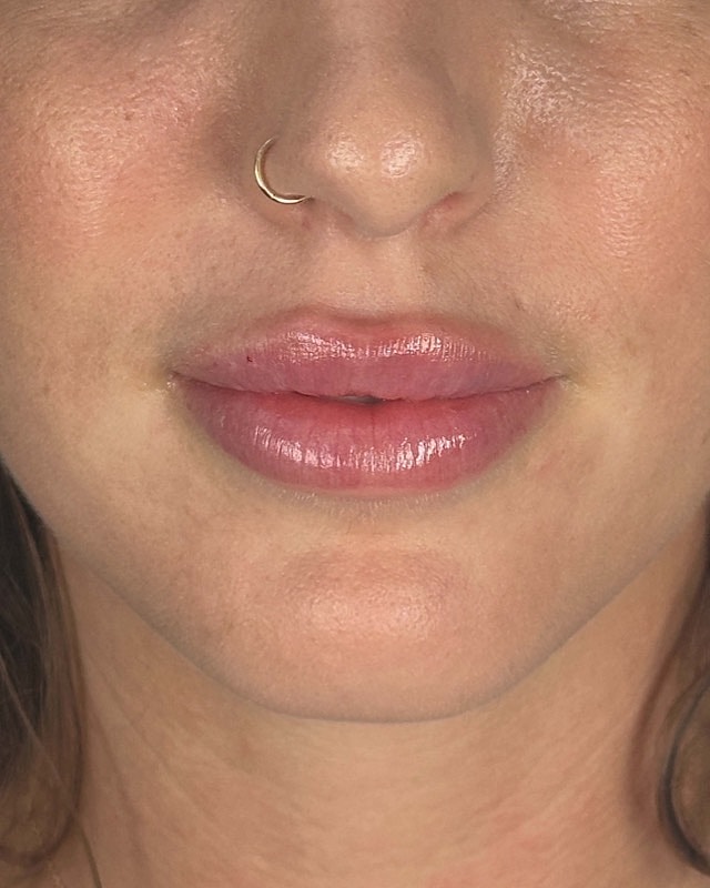 Juvederm Before & After
