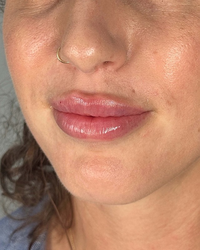 Juvederm Before & After
