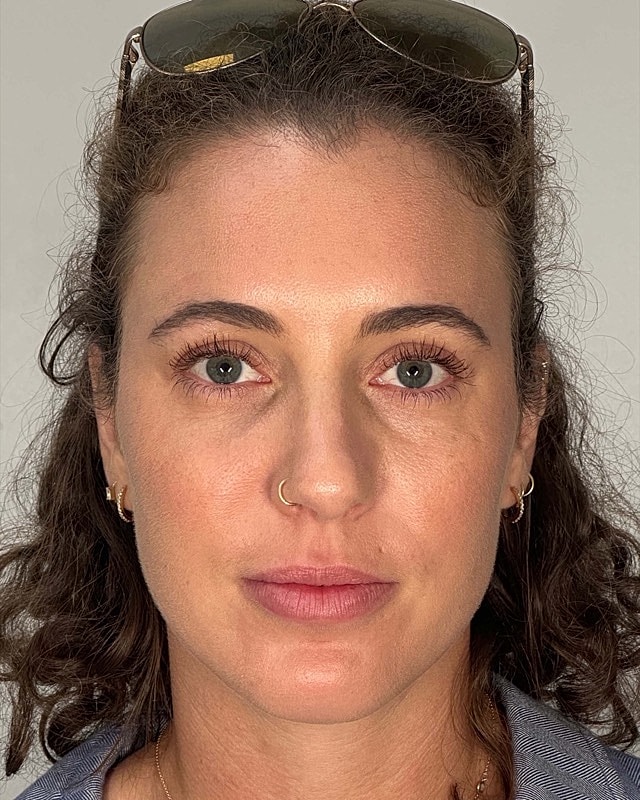 Juvederm Before & After