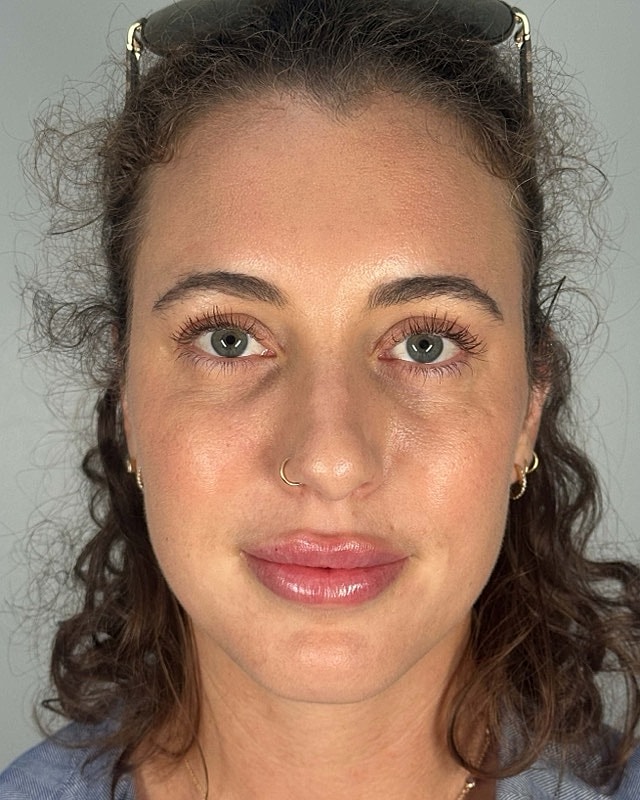 Juvederm Before & After